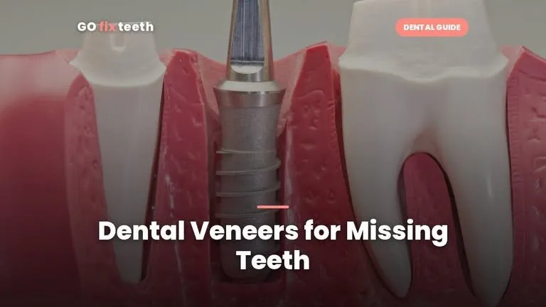 Dental Veneers for Missing Teeth: What Works Instead