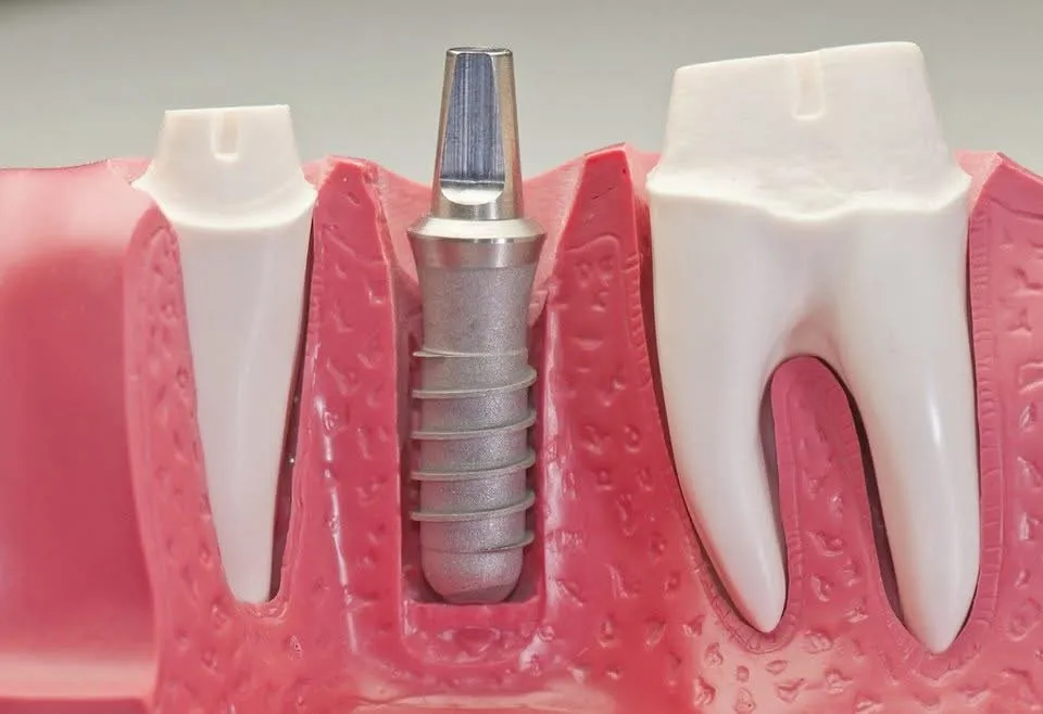 Model of a dental implant placed in the jawbone between two natural teeth