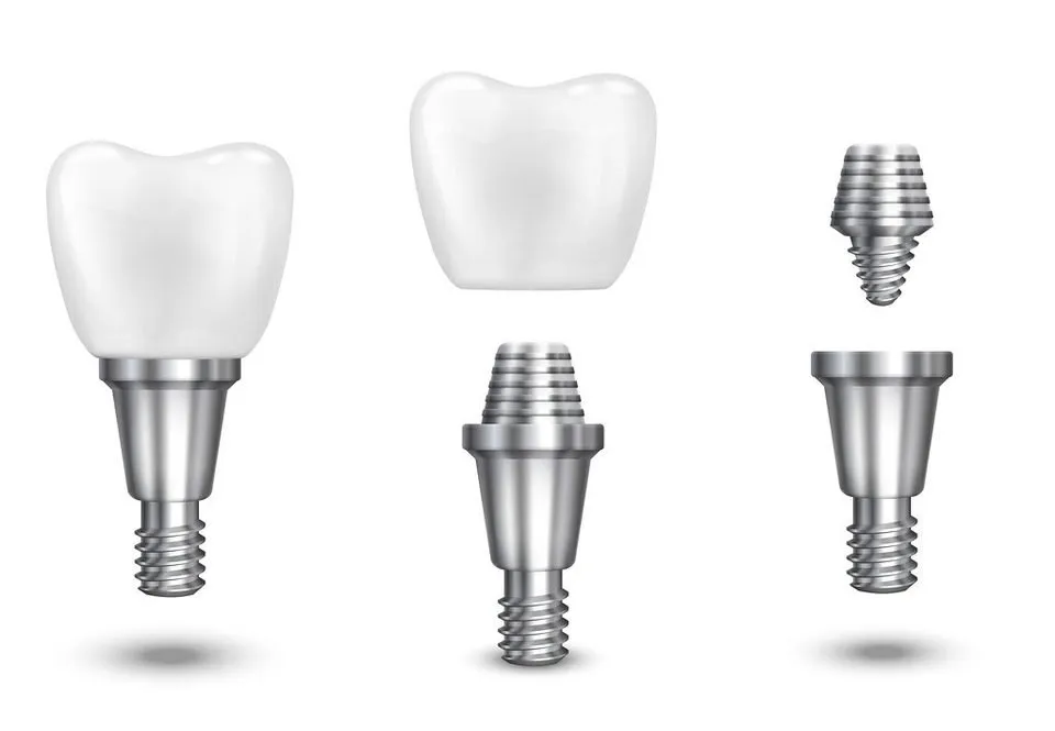 Dental crowns and implant abutments, two of the parts that drive the cost of a tooth crown