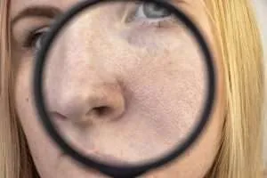 Expanded pores, black spots, acne