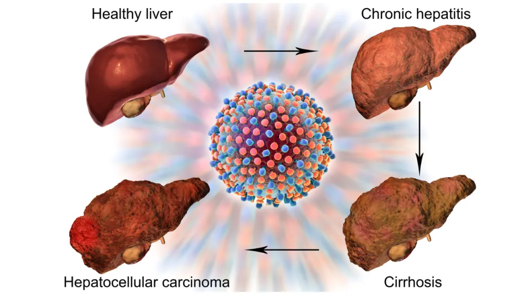 Liver Diseases