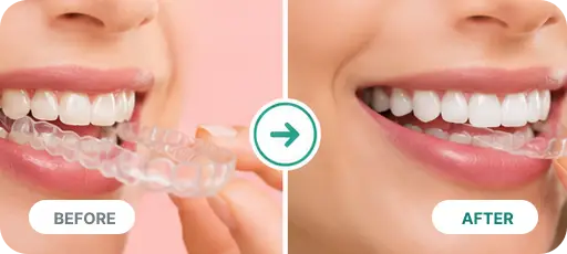 Invisalign