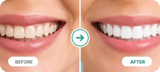 Veneers