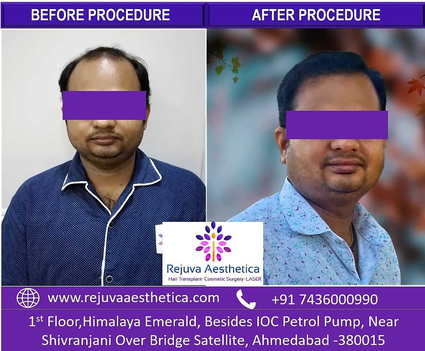 Hair Transplant in Ahmedabad