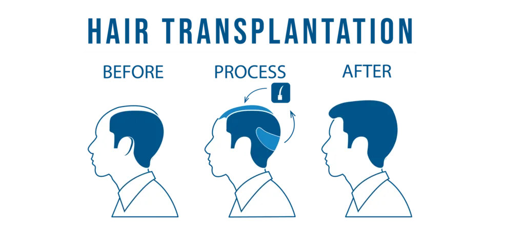 Hair Transplant ke kya charges hai
