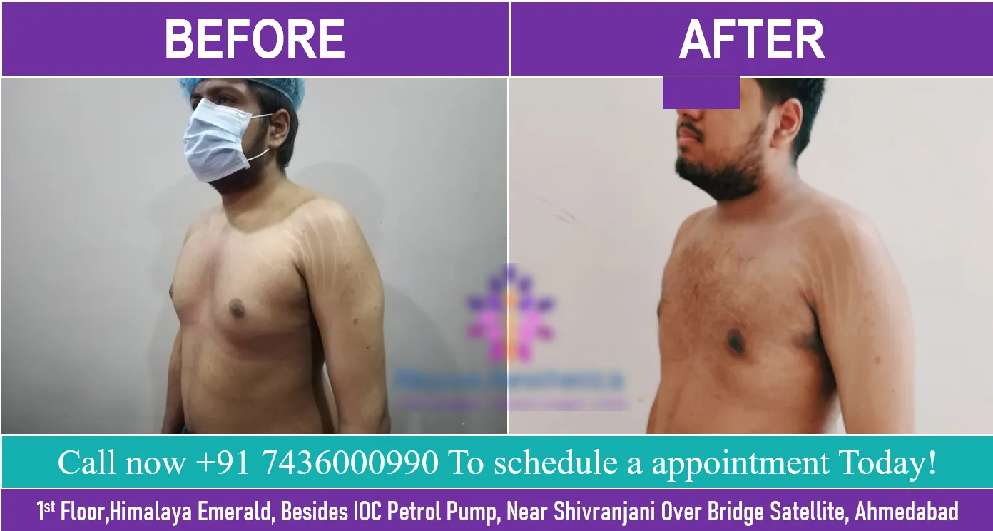Top Gynecomastia Surgeon In India