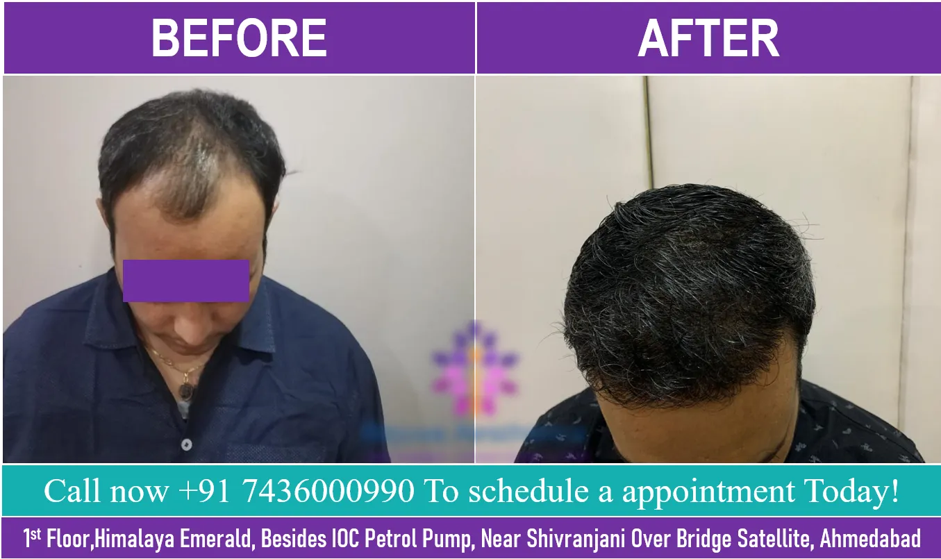 Best Hair Transplant Results in Ahmedabad,Gujarat
