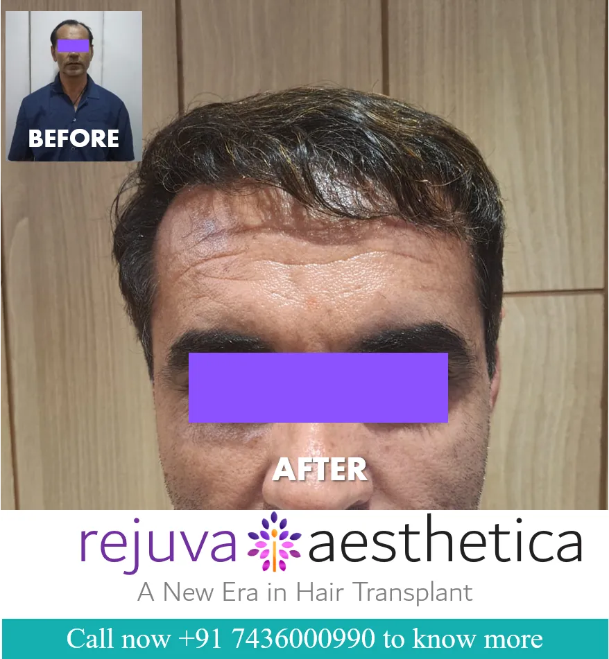 Hair Transplant in Ahmedabad | Hair Transplant in Gujarat