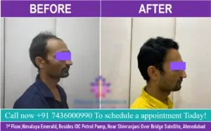 Best Hair Transplant Clinic in Ahmedabad