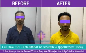 Best Hair Transplant in Ahmedabad,Gujarat