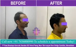 Hair Transplant cost in Gujarat