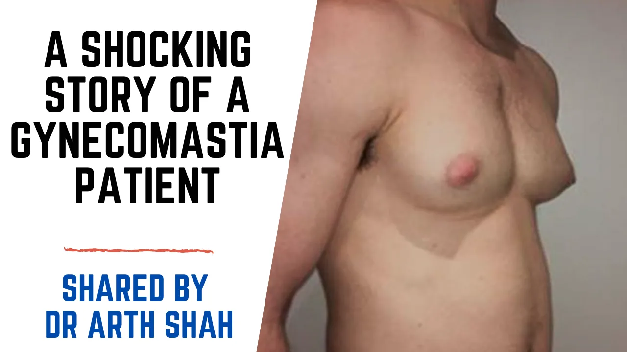 Gynecomastia Surgery in Gujarat,India