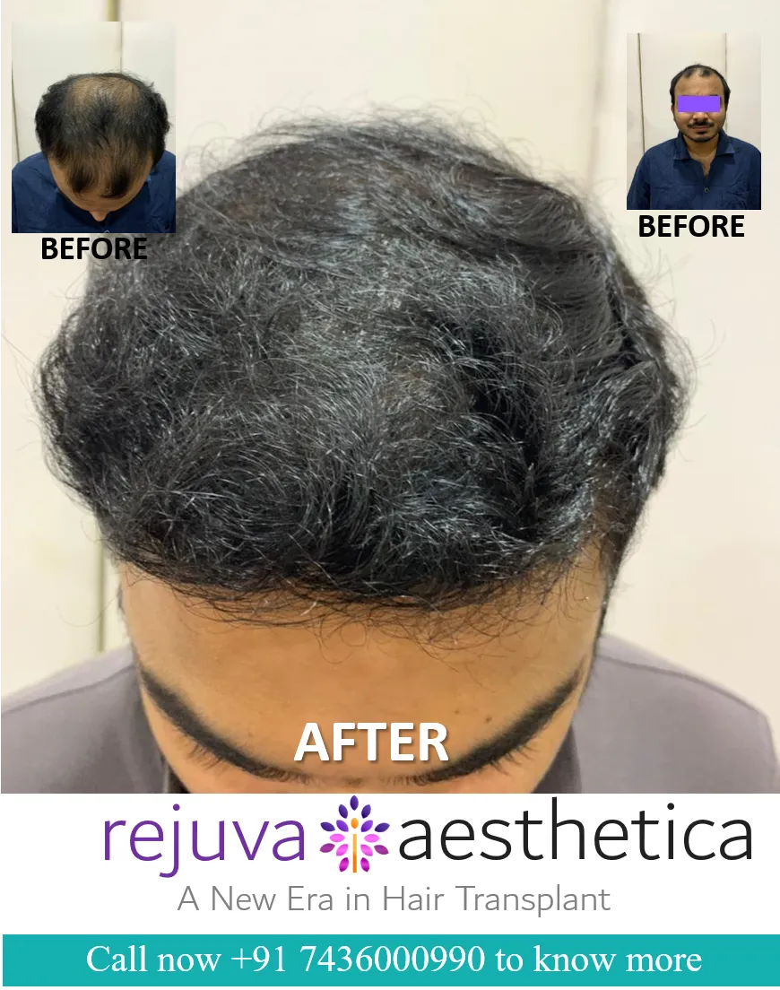 hair transplant in ahmedabad best doctor