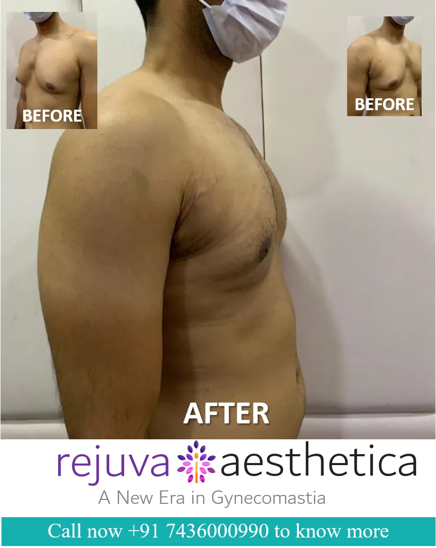 Gynecomastia (Enlarged Breast in Men) Surgery in Gujrat India
