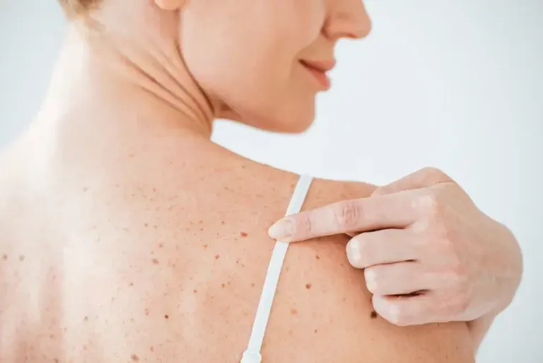 Mole removal Surgery in Ahmedabad