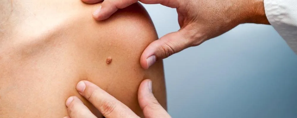 Sebaceous Cyst Treatment