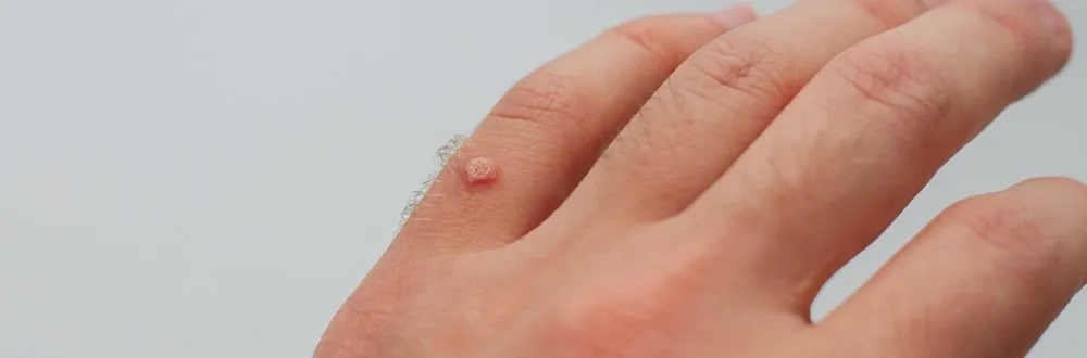 Wart Removal Treatment In Ahmedabad