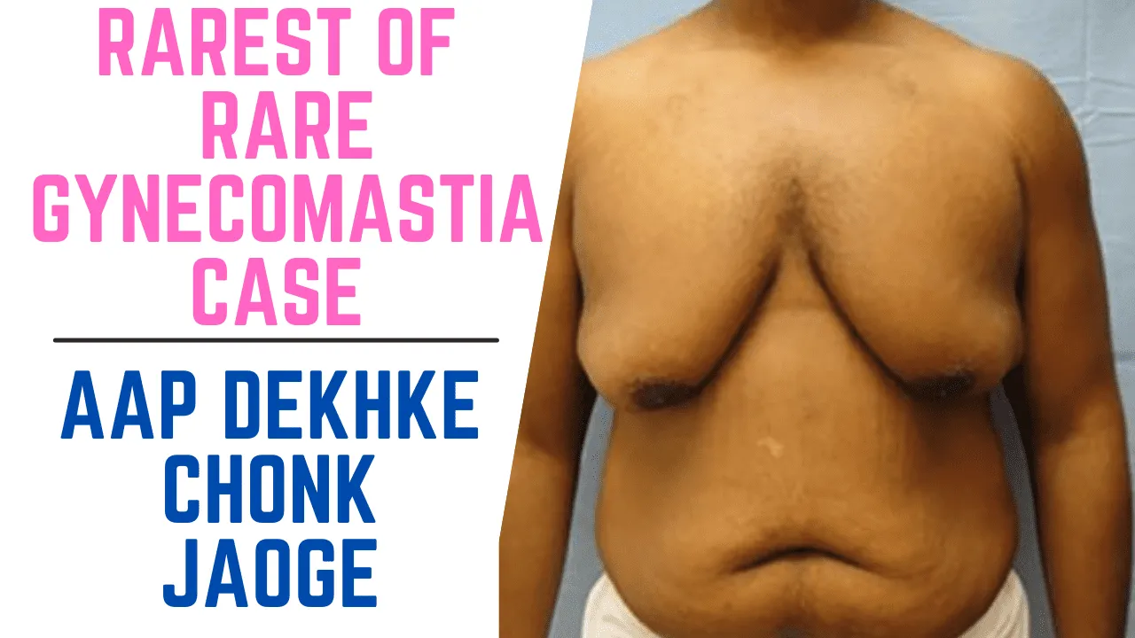 Gynecomastia Surgery in Gujarat by Dr Arth Shah