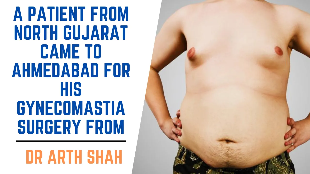 Patient with Gynecomastia came to ahmedabad to get treated by dr Arth Shah