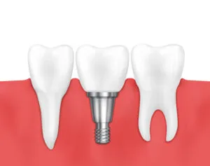 dental implant service san dimas
