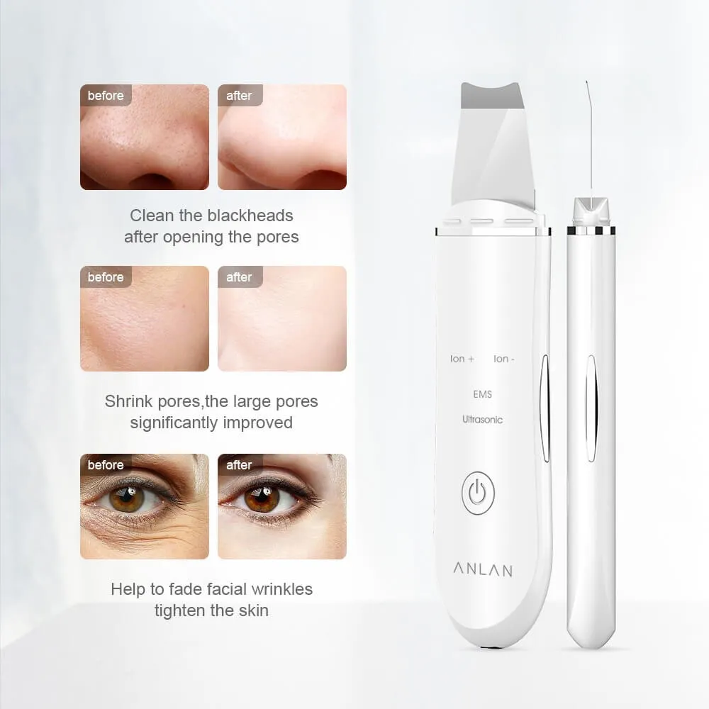 מכשיר מתקדם לניקוי פנים עמוק והסרת שחורים ULTRASONIC מבית ANLAN – תמונה 2