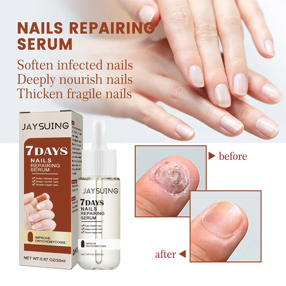 Nail Fungus Treatment Serum Toe Fungal Repair Products Hand Foot Care Removal Gel Anti Infection Onychomycosis Paronychia Nail Fungus Treatment Serum Toe Fungal Repair Products Hand Foot Care Removal Gel Anti Infection Onychomycosis Paronychia