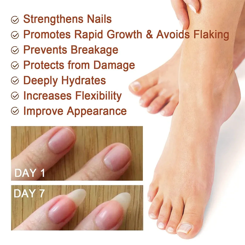 Nail Fungus Treatment Serum Toe Fungal Repair Products Hand Foot Care Removal Gel Anti Infection Onychomycosis Paronychia Nail Fungus Treatment Serum Toe Fungal Repair Products Hand Foot Care Removal Gel Anti Infection Onychomycosis Paronychia