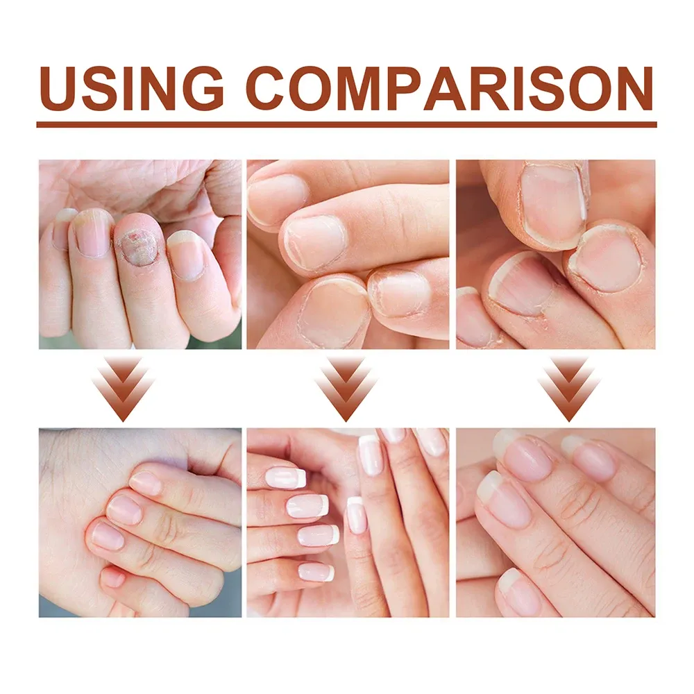 Nail Fungus Treatment Serum Toe Fungal Repair Products Hand Foot Care Removal Gel Anti Infection Onychomycosis Paronychia Nail Fungus Treatment Serum Toe Fungal Repair Products Hand Foot Care Removal Gel Anti Infection Onychomycosis Paronychia