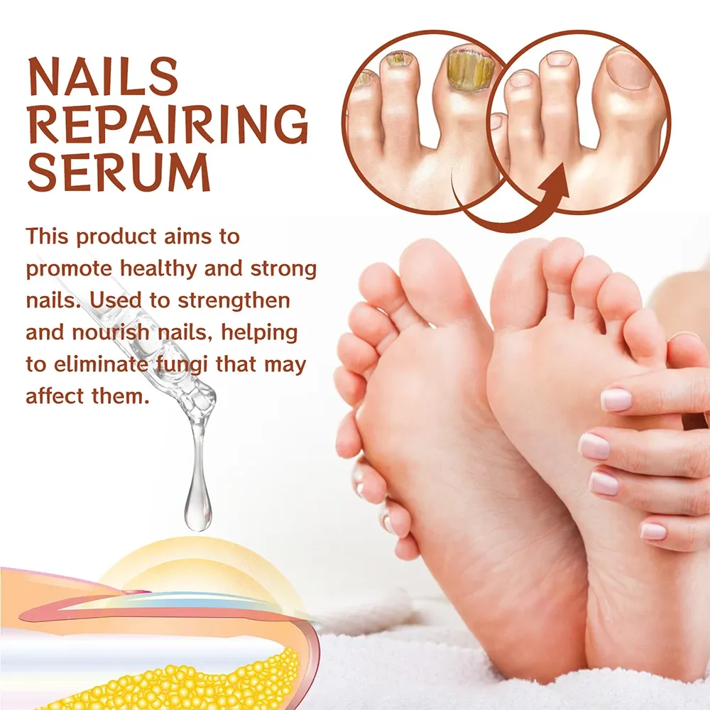 Nail Fungus Treatment Serum Toe Fungal Repair Products Hand Foot Care Removal Gel Anti Infection Onychomycosis Paronychia Nail Fungus Treatment Serum Toe Fungal Repair Products Hand Foot Care Removal Gel Anti Infection Onychomycosis Paronychia