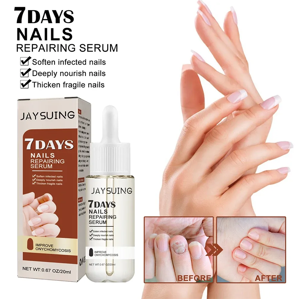 Nail Fungus Treatment Serum Toe Fungal Repair Products Hand Foot Care Removal Gel Anti Infection Onychomycosis Paronychia Nail Fungus Treatment Serum Toe Fungal Repair Products Hand Foot Care Removal Gel Anti Infection Onychomycosis Paronychia
