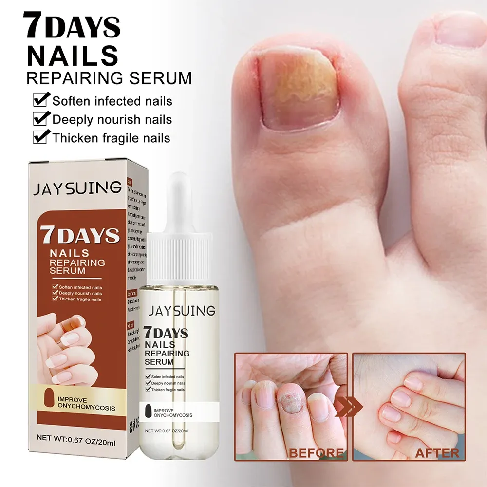 Nail Fungus Treatment Serum Toe Fungal Repair Products Hand Foot Care Removal Gel Anti Infection Onychomycosis Paronychia Nail Fungus Treatment Serum Toe Fungal Repair Products Hand Foot Care Removal Gel Anti Infection Onychomycosis Paronychia