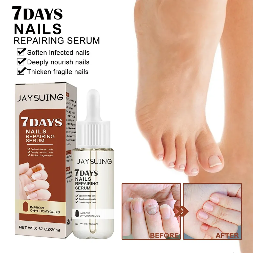 Nail Fungus Treatment Serum Toe Fungal Repair Products Hand Foot Care Removal Gel Anti Infection Onychomycosis Paronychia Nail Fungus Treatment Serum Toe Fungal Repair Products Hand Foot Care Removal Gel Anti Infection Onychomycosis Paronychia