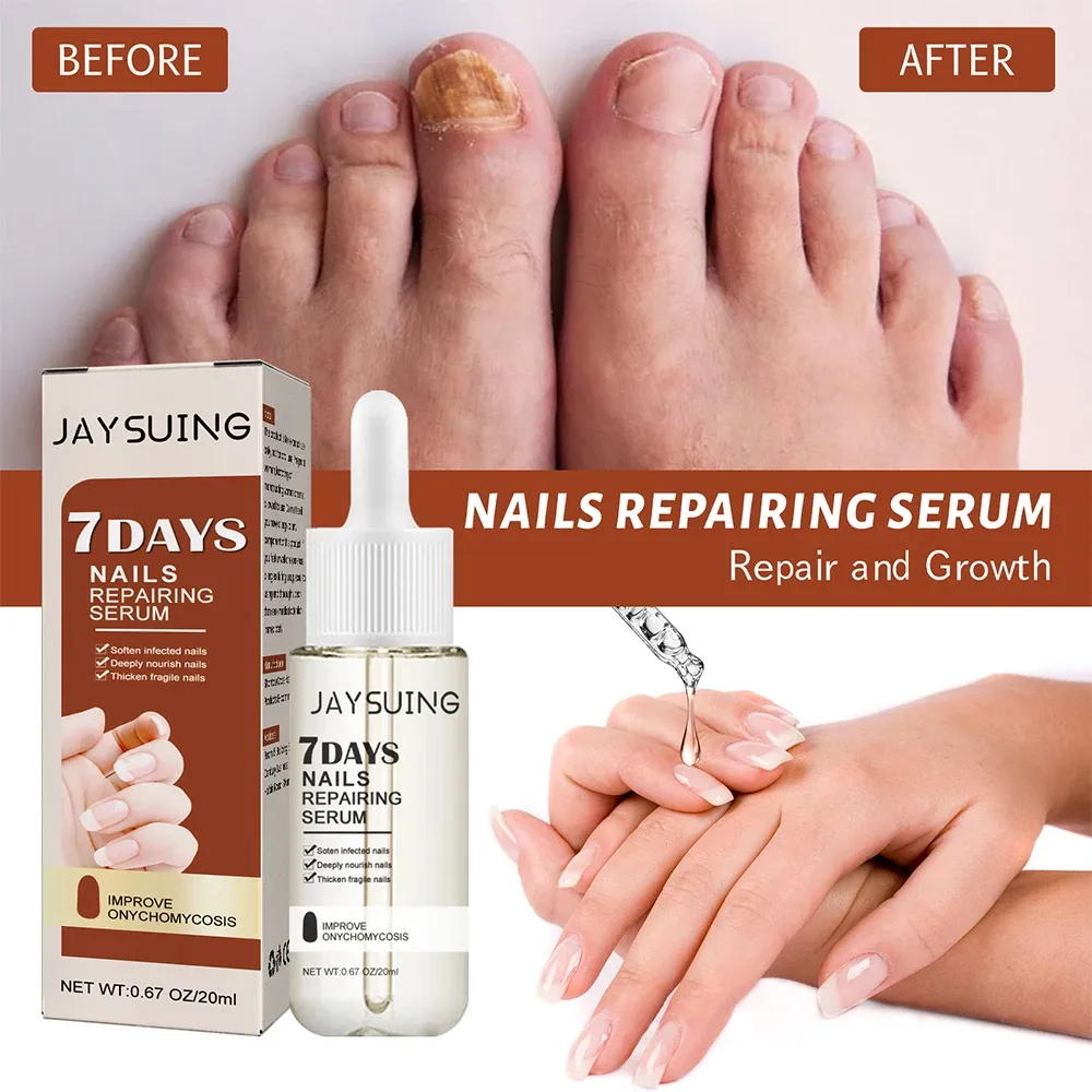 Nail Fungus Treatment Serum Toe Fungal Repair Products Hand Foot Care Removal Gel Anti Infection Onychomycosis Paronychia Nail Fungus Treatment Serum Toe Fungal Repair Products Hand Foot Care Removal Gel Anti Infection Onychomycosis Paronychia