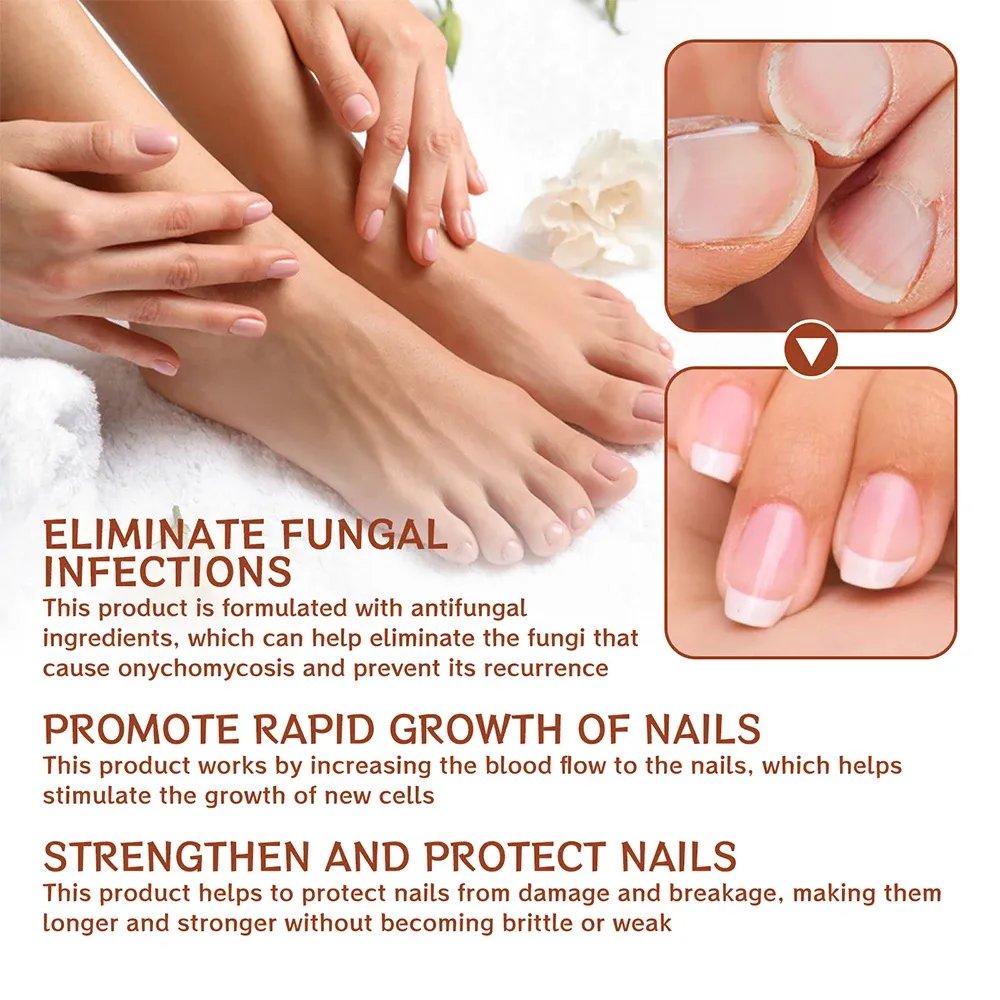 Nail Fungus Treatment Serum Toe Fungal Repair Products Hand Foot Care Removal Gel Anti Infection Onychomycosis Paronychia Nail Fungus Treatment Serum Toe Fungal Repair Products Hand Foot Care Removal Gel Anti Infection Onychomycosis Paronychia
