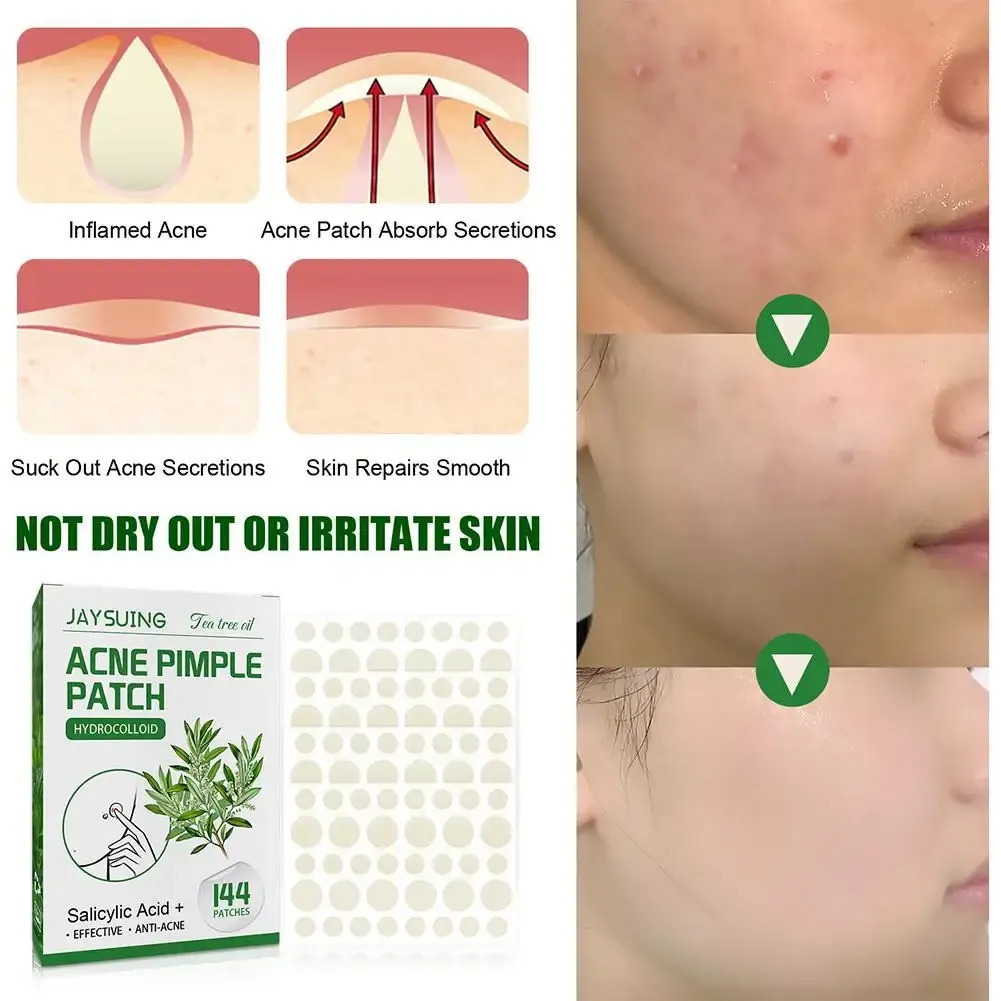 144pcs Hydrocolloid Salicylic Acid Acne Pimple Patches Treatment For Zits Blemishes Tea Tree Oil Control Redness Repair 144pcs Hydrocolloid Salicylic Acid Acne Pimple Patches Treatment For Zits Blemishes Tea Tree Oil Control Redness Repair