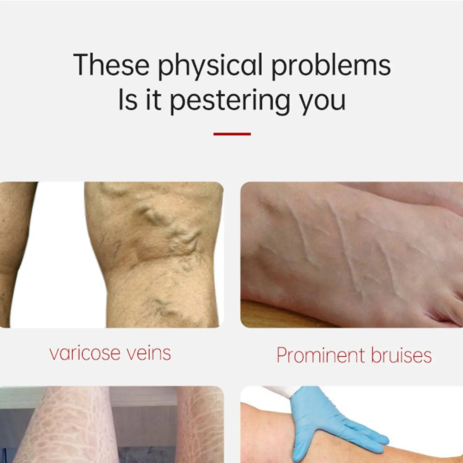 Varicose Vein Relief Paste Improve Blood Circulations Spider Varicose Vein For Tired Heavy Legs Fast Relief New Varicose Vein Relief Paste Improve Blood Circulations Spider Varicose Vein For Tired Heavy Legs Fast Relief New