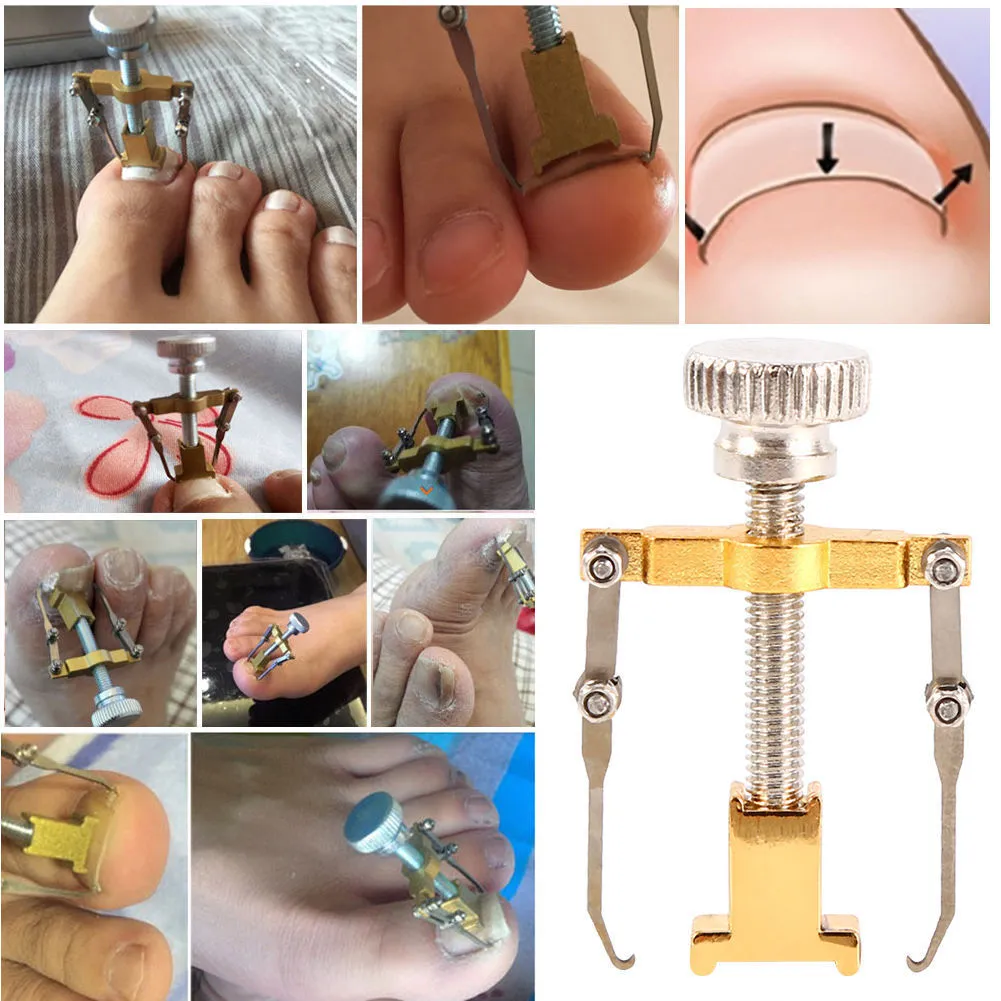 ⁦מיישר ציפורן חודרנית מקצועי לידיים וגם לרגליים⁩ – תמונה ⁦2⁩