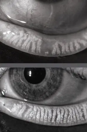 Black and white close-up of eyelids exposing prominent white vertical meibomian glands.