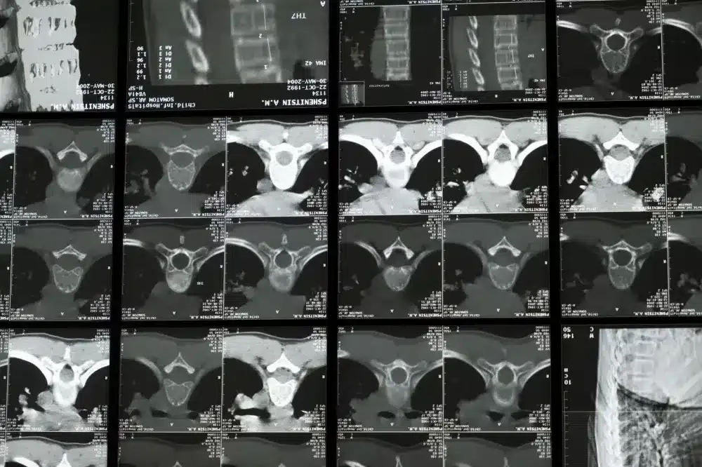 Intrathecal Pain Pump in Plano, TX | Same-Week Consults 2 Anatomical spine model showing intrathecal space relevant to pain pump placement