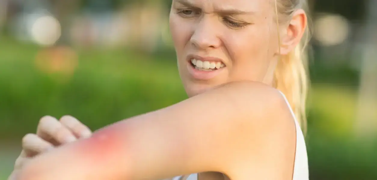 wasp sting wasp sting