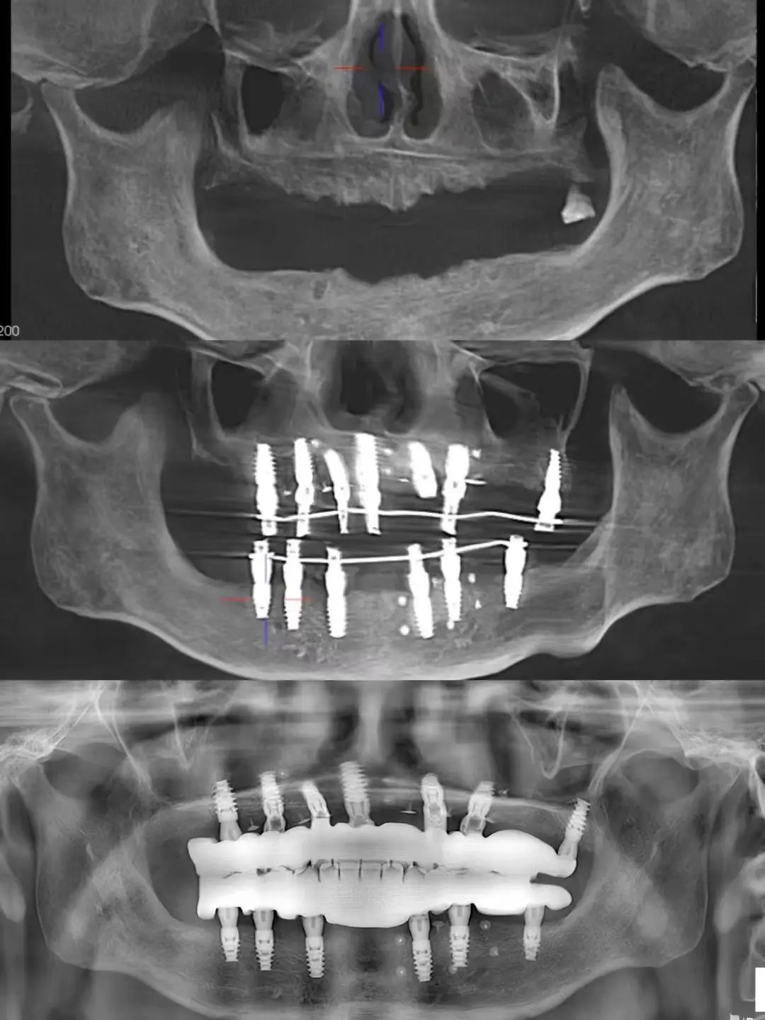 デンタルマスターの無歯顎症例 - DentalMaster｜デンタルインプラント