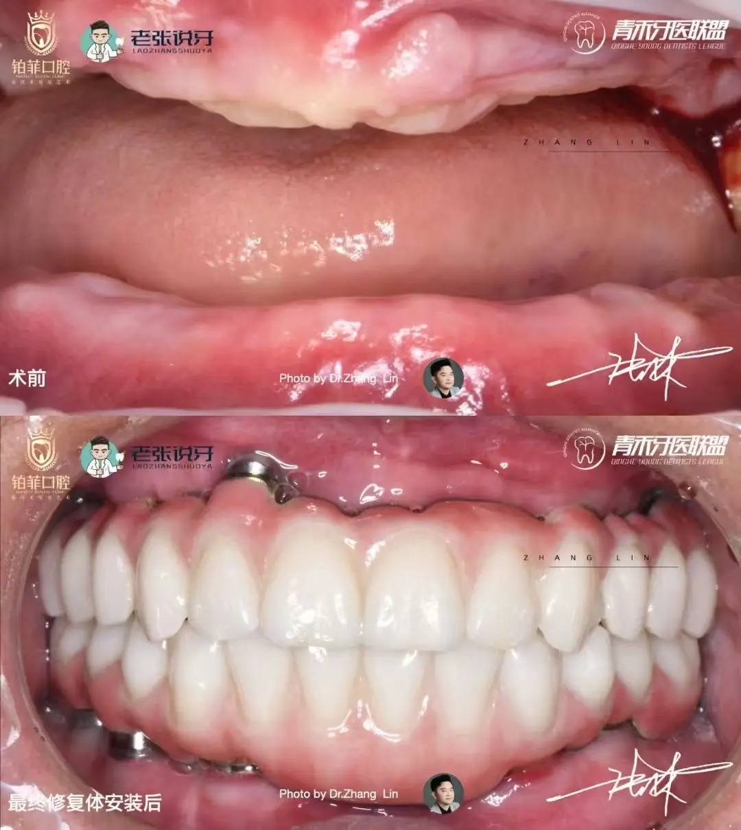 デンタルマスターの無歯顎症例 - DentalMaster｜デンタルインプラント