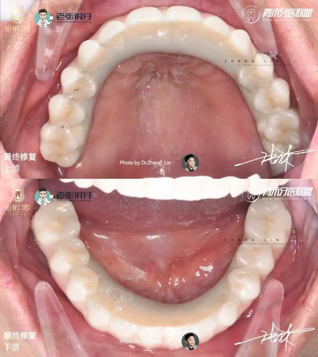 デンタルマスターの無歯顎症例 - DentalMaster｜デンタルインプラント