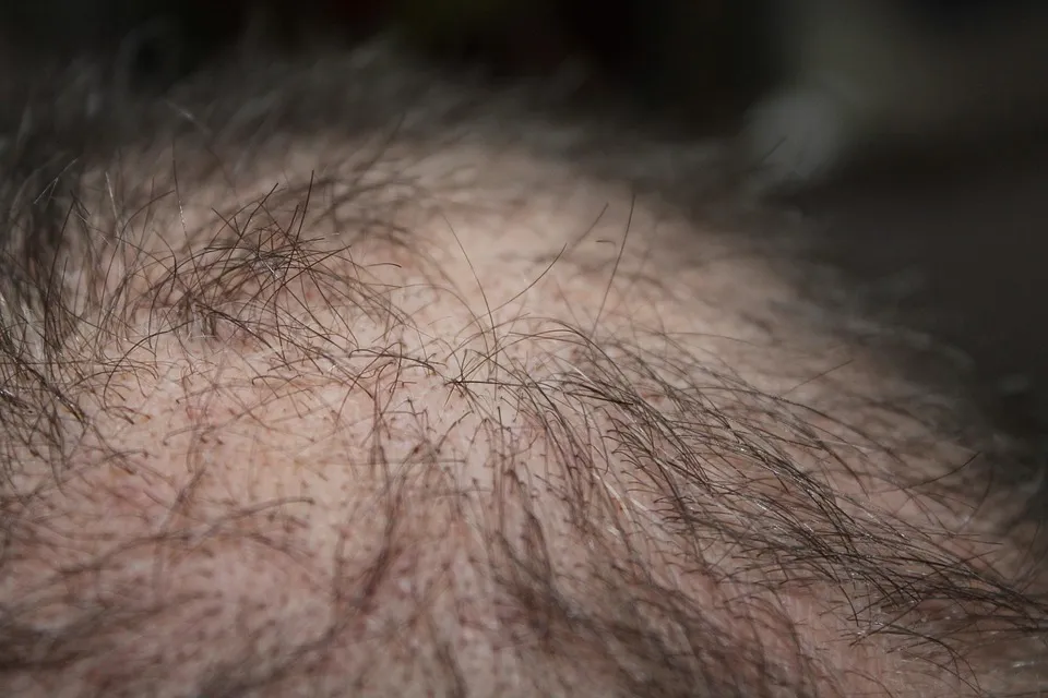 Azelaic Acid for Hair Loss Free photos of Hair