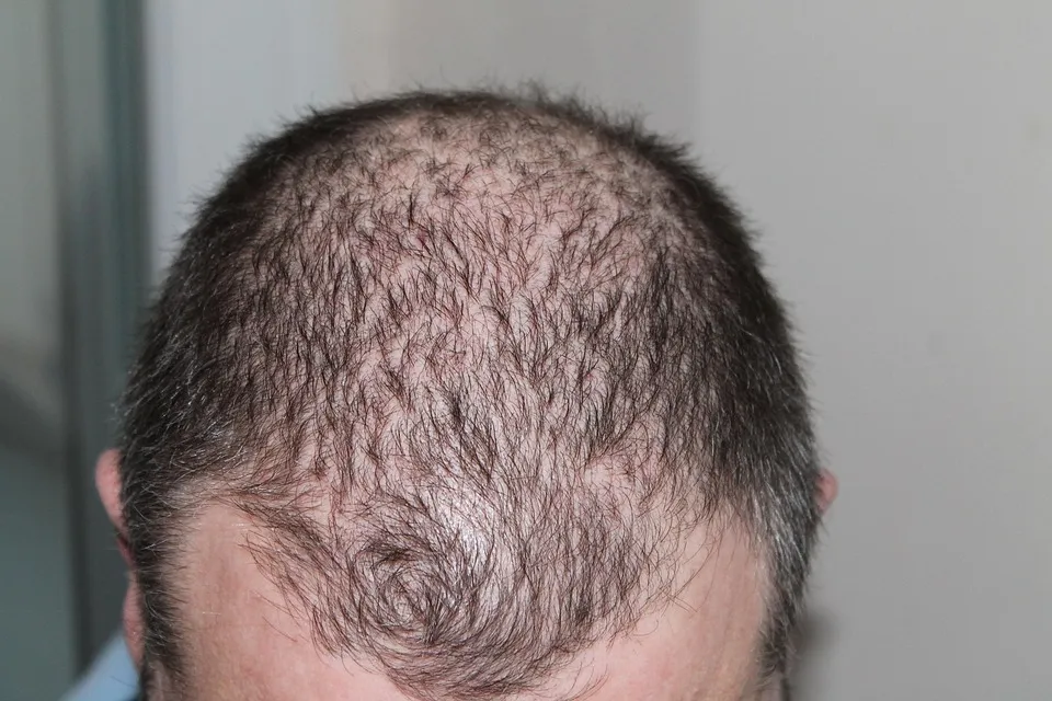 Does Creatine Cause Hair Loss? Free photos of Hair