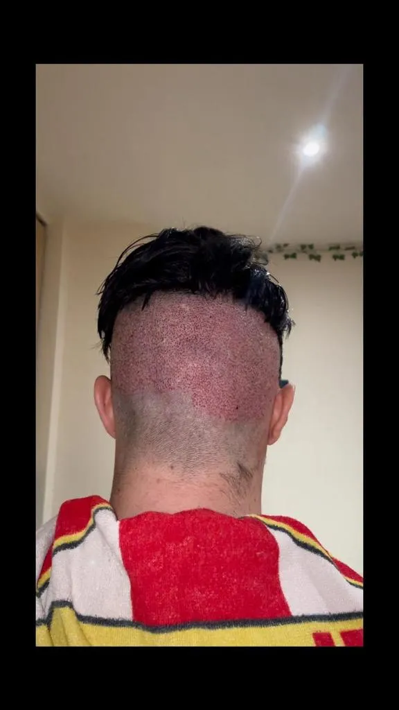 Donor Area for Hair Transplant e35de89b bb12 40c1 8fed 3a214fe83375