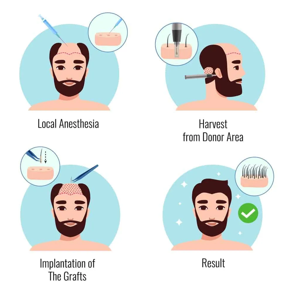 Harley Street Hair Transplant Clinics London Home Page Hair Transplant Procedure and process-min