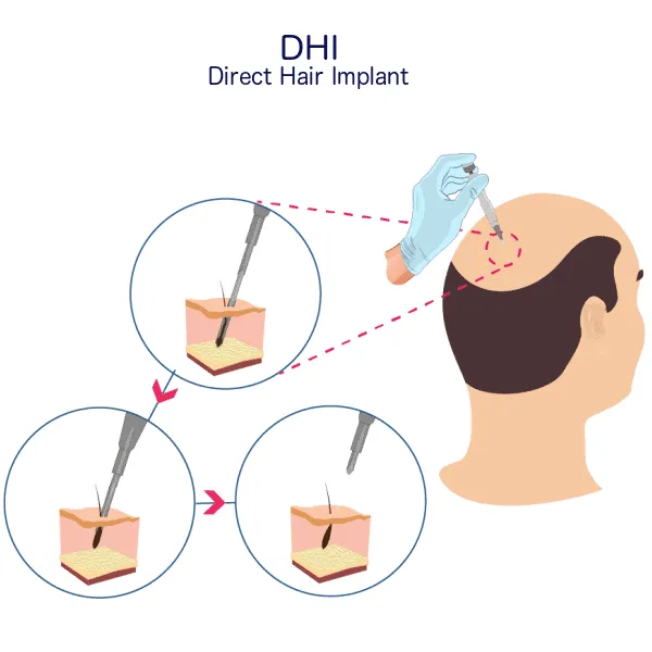 DHI Hair Transplant DHI Hair Transplant Procedure-min
