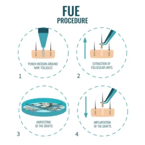 Donor Area for Hair Transplant FUE Hair Transplant Procedure