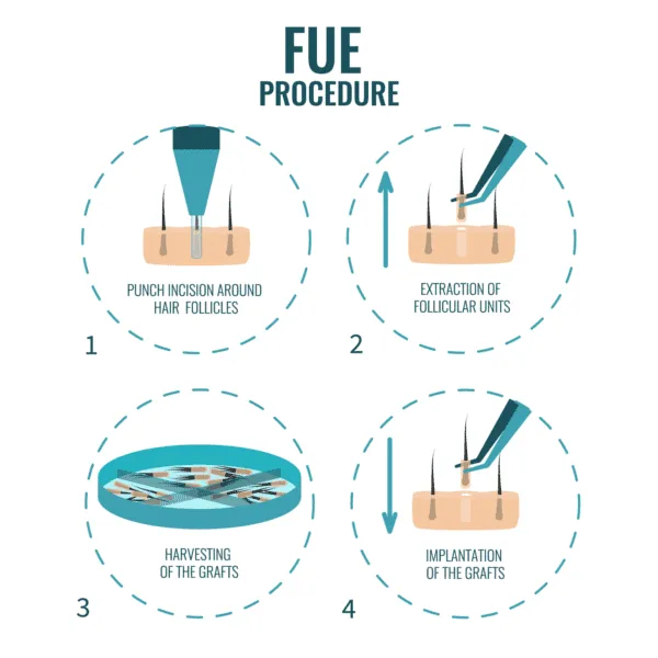 Beard Transplant in Manchester FUE Hair Transplant Procedure